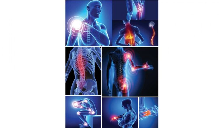 Ejemplos Comunes de Trastornos Musculoesqueléticos en la Población